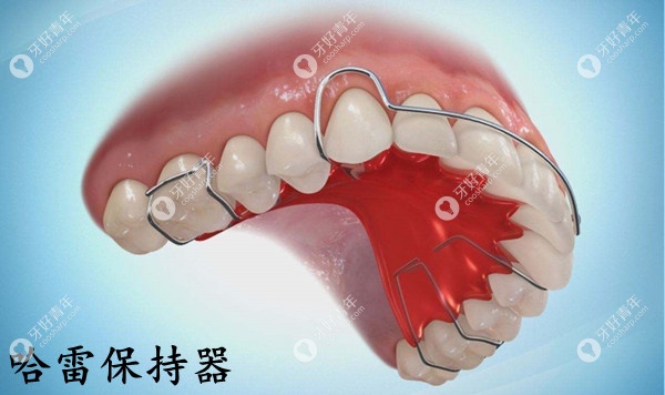 哈雷Hawley保持器多少钱