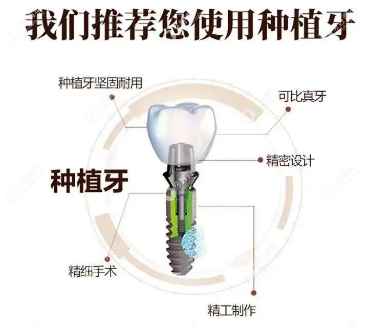 牙齿缺失选择种植牙的优点（容易美口腔网）