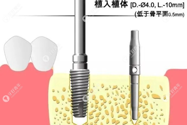 种植牙多少钱一颗2022价格表