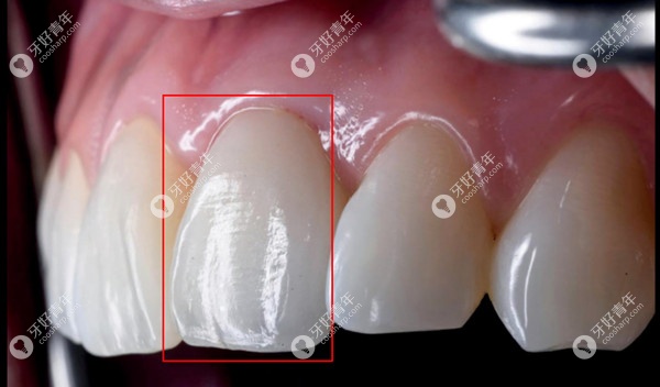 瑞士士卓曼BLX种植体做即刻种植牙后的照片