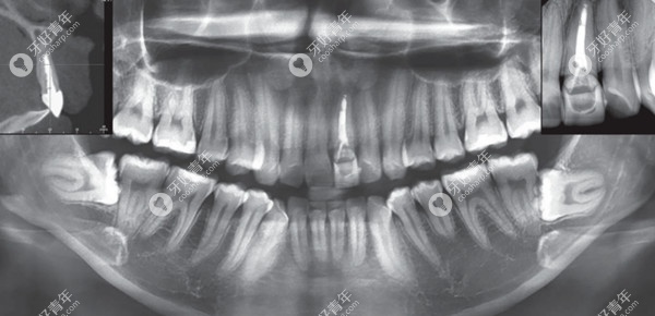 前牙区牙槽骨薄种植牙前CT片