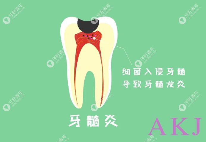牙髓炎科普图