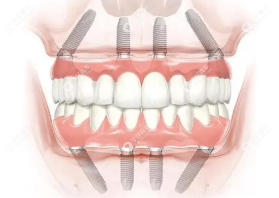 老人全口种植牙价格