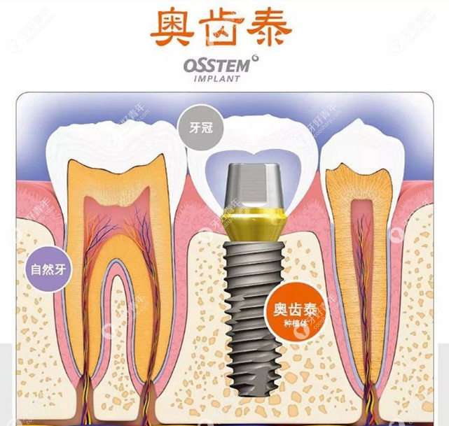 韩国奥齿泰种植牙系统