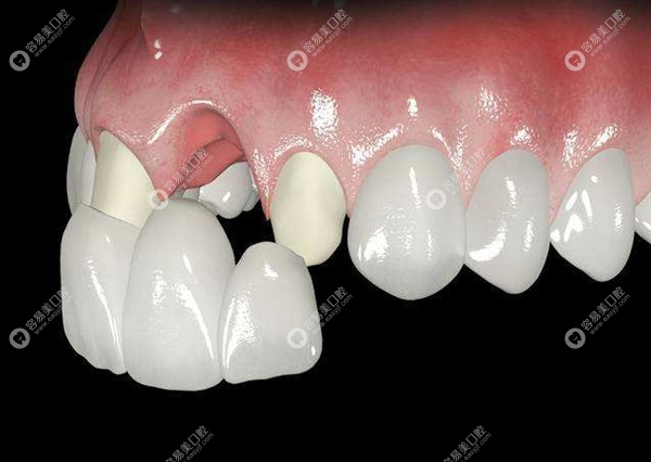 固定牙种植牙活动牙区别介绍