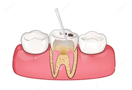 牙齿根管治疗全过程第3步：杀神经