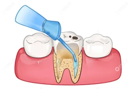 牙齿根管治疗全过程第2步：根管冲洗