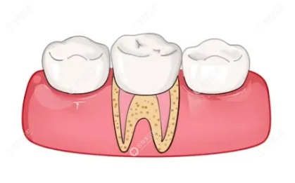 牙齿根管治疗全过程第5步：戴牙冠