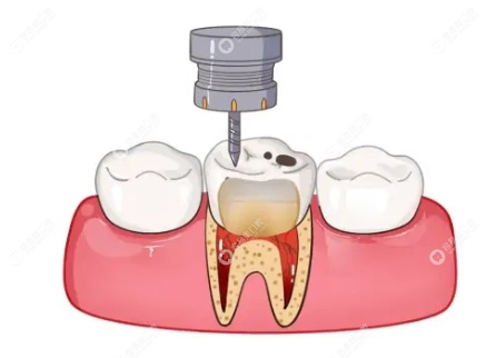 牙齿根管治疗全过程起步：开髓
