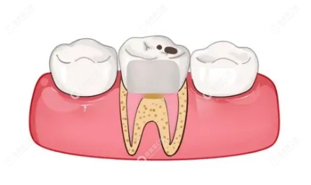 牙齿根管治疗全过程第4步：填充