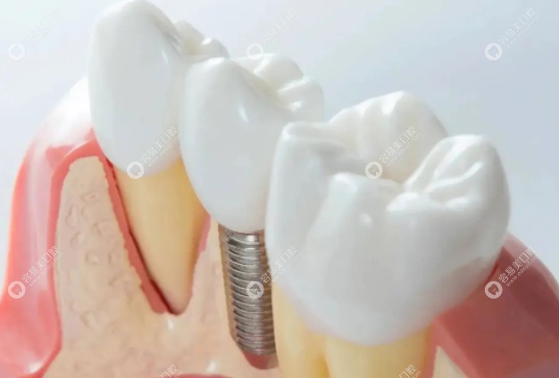 重视口腔卫生有利于避免种植牙发炎
