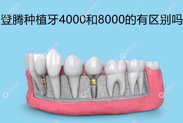 登腾种植牙4000和8000的有区别吗