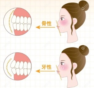 骨性与牙性的区别