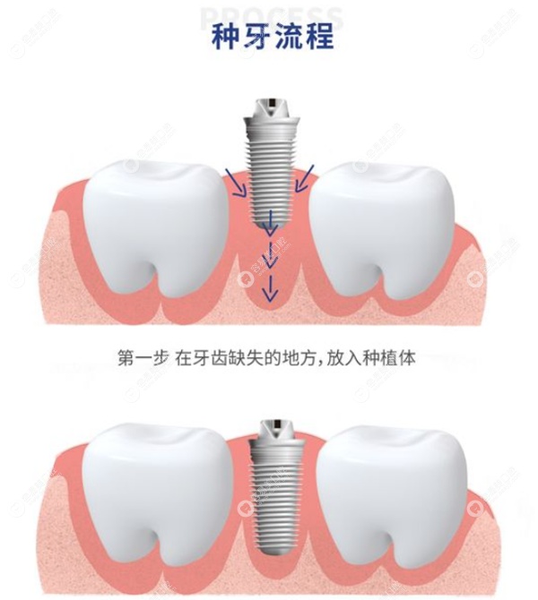 杭州萧山牙科医院种植牙容易美口腔