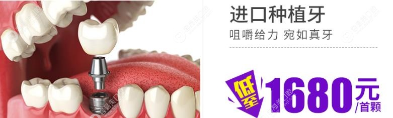 广州广大口腔医院进口种植牙集采价格-容易美