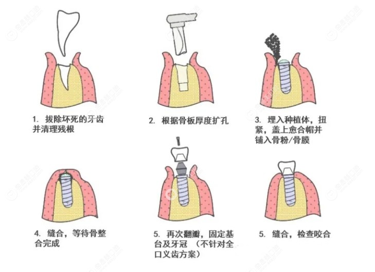 种植牙图解全过程