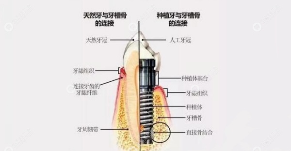 种植牙各个部件的名称图解
