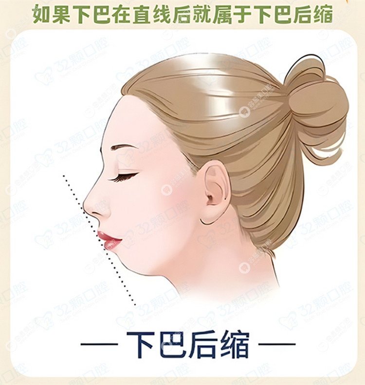 下巴后缩骨性和牙性的区别：