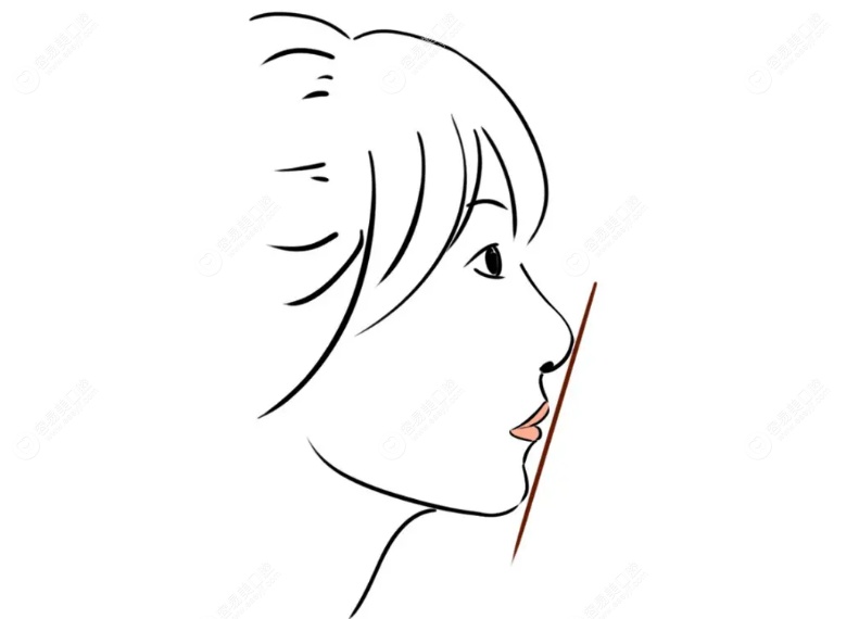 骨性下巴后缩如何矫正？