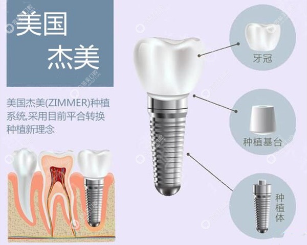 2023美国种植牙品牌排行榜名称及价格:美国皓圣6000+/百康7000+