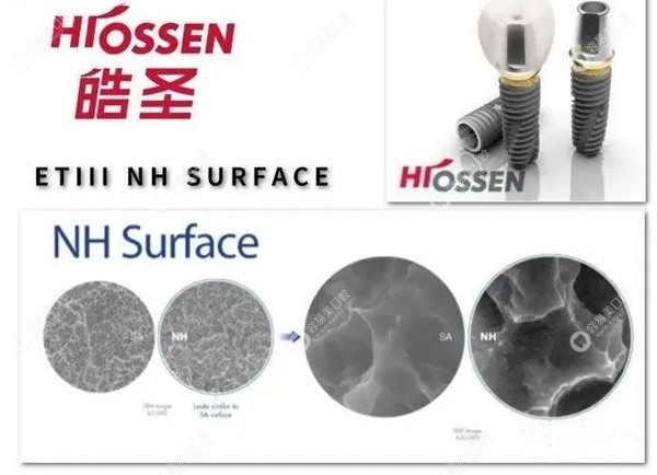 2023美国种植牙品牌排行榜名称及价格:美国皓圣6000+/百康7000+