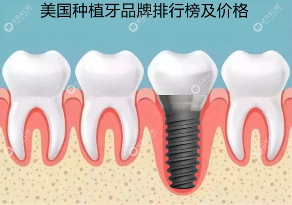 2023美国种植牙品牌排行榜名称及价格:美国皓圣6000+/百康7000+