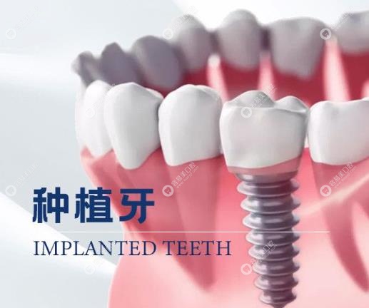 成都牙管家口腔种植牙价格多少钱
