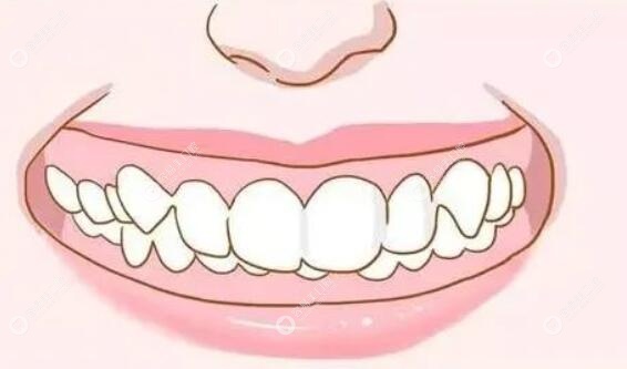 深覆合但是牙齿非常整齐怎么矫正?牙齿深覆合矫正难度大吗?