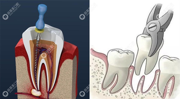 根管治疗还不如直接拔牙?牙齿龋坏根管治疗和拔牙各有优势