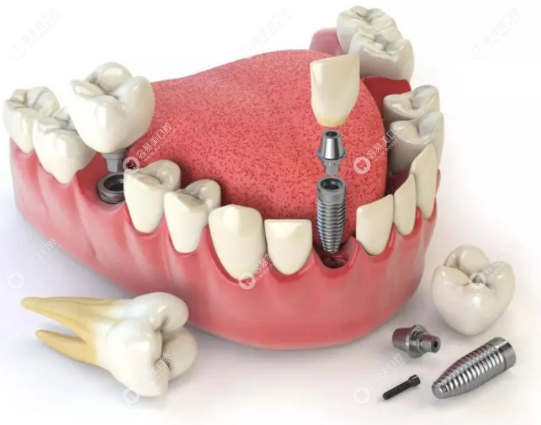 种植一颗进口门牙大概需要多少钱?韩国进口4000起瑞士1.2万+
