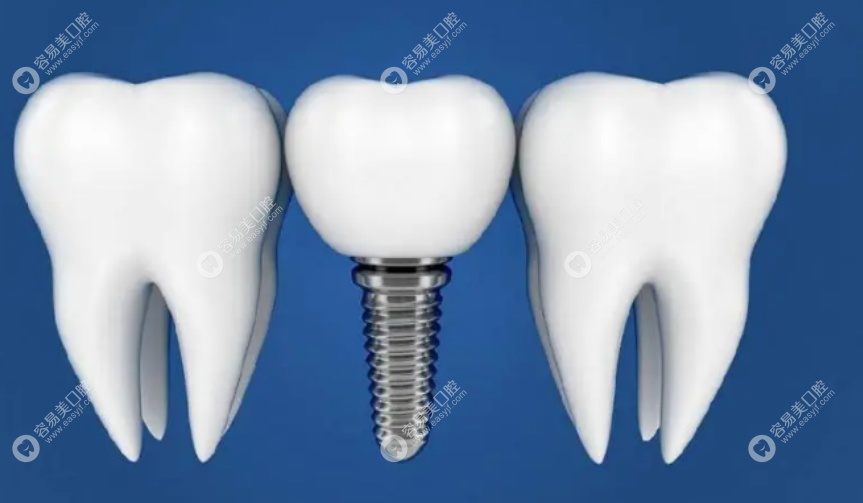 种植一颗进口门牙大概需要多少钱?韩国进口4000起瑞士1.2万+