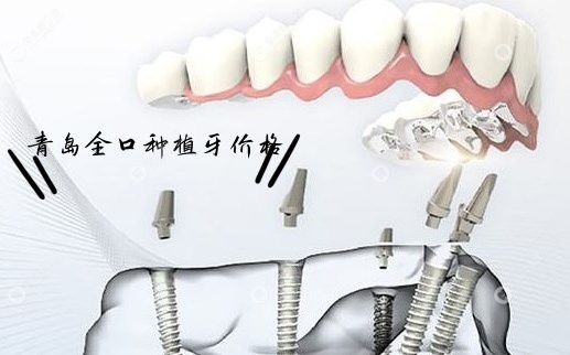 青岛全口种植牙价格表