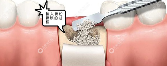 缺牙时间过长可能需要植骨后才能种牙