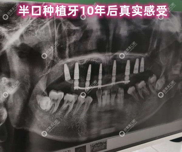 半口种植牙10年后真实感受