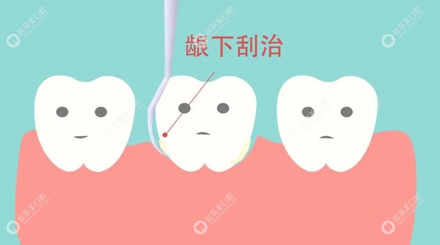 龈下刮治是一种治疗牙周病的常见方法