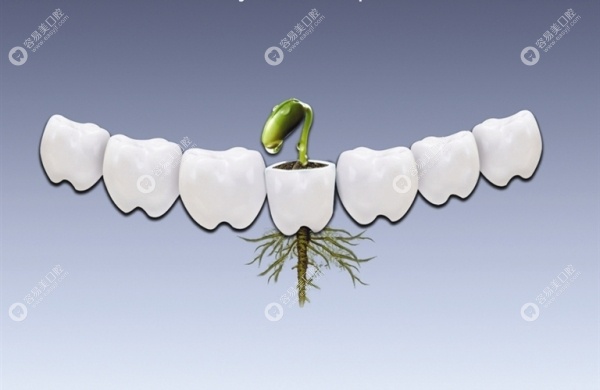 龈下刮治后牙齿掉了可以做种植义齿