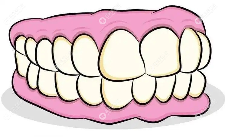 龈下刮治后牙齿掉了可以做固定义齿