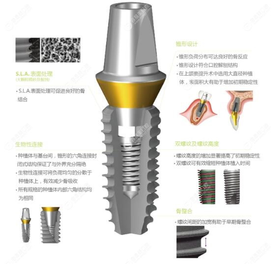登腾植体型号二