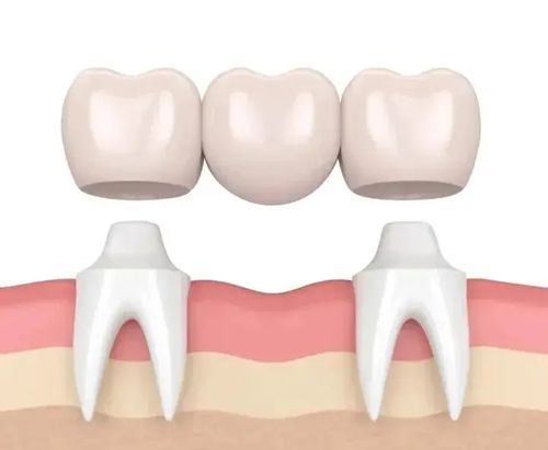 广州广大口腔医院的种牙价格不贵