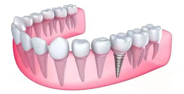 潍坊华贝口腔和可恩口腔收费标准