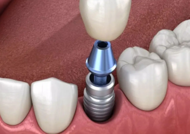 深圳尔睦口腔种植牙靠谱吗？数字化种牙技术，误差控制在0.1毫米内