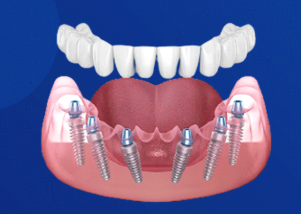 深圳尔睦口腔种植牙靠谱吗