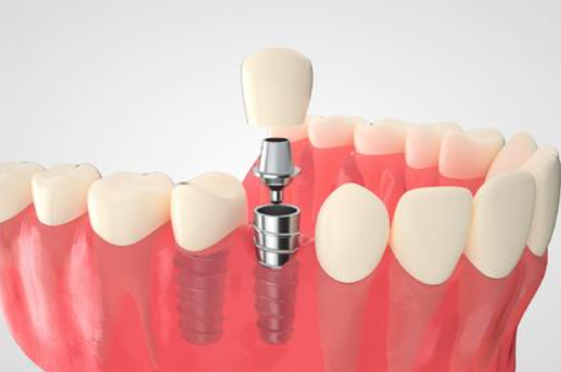 扬州贝恩口腔费用高吗？韩国登腾种植牙价格3980元/颗起，相比同类型机构便宜10-15%