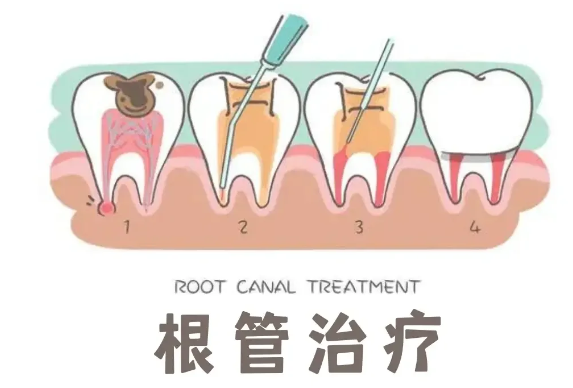 深圳鼎植口腔根管靠谱吗