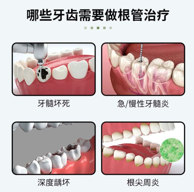 深圳鼎植口腔根管靠谱吗？连锁技术：显微镜+热牙胶充填系统+数字化导航
