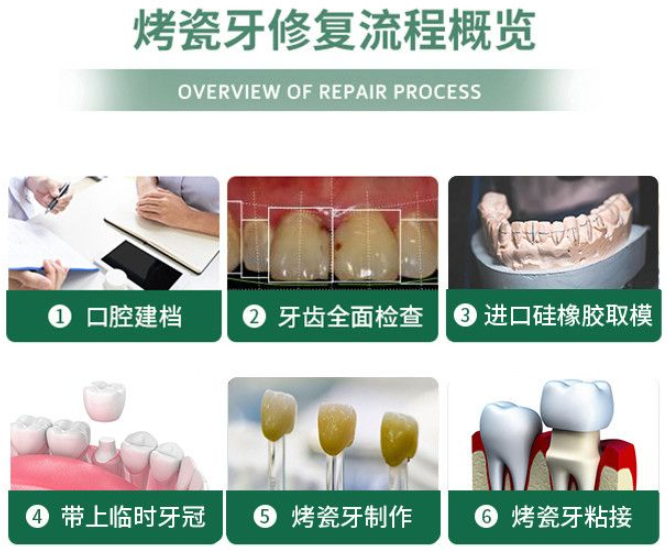 天津镶牙多少钱一颗牙？2026年烤瓷牙/全瓷牙/种植牙价格大对比