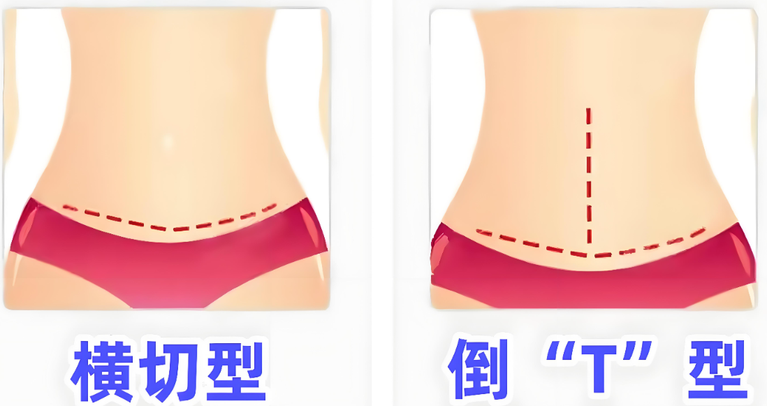 深圳腹壁成型手术医院排名5详细介绍