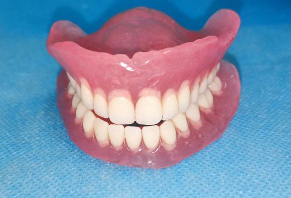 吸附式全口义齿