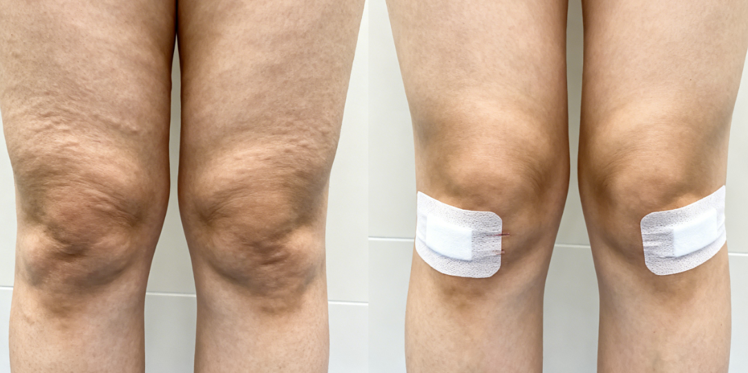 深圳曹孟君吸脂技术对比与患者真实实例数据