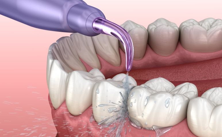 洗牙前的注意事项